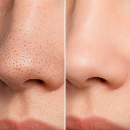 Blackhead Remover